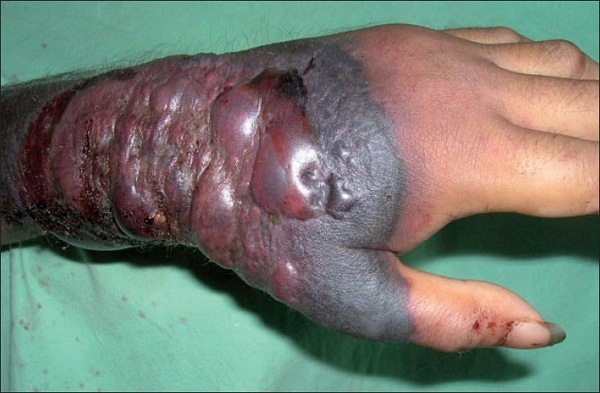 Ebola victi hand