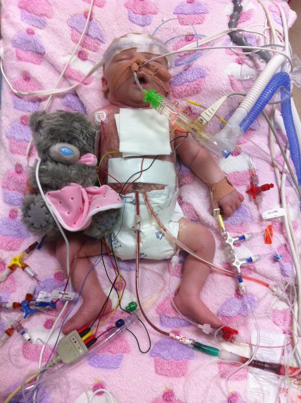 Chanel Murrish becomes the world's youngest open heart surgery patient at one minute old!