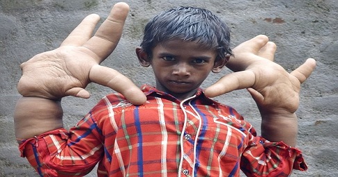 8-Year Old Boy With Giant Hands Undergoes Life-Saving Surgery