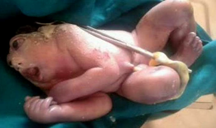 Woman Gives Birth To Frog Like Baby In Rajasthan