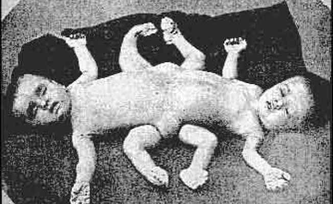 Nazi Conjoined Twins Experiment- Sewing Twins Together