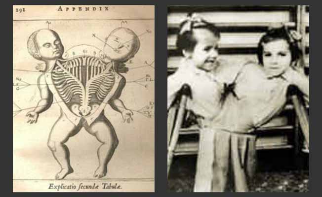 Nazi Conjoined Twins Experiment- Sewing Twins Together