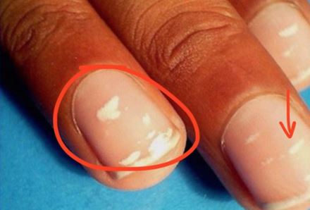 White spots on Nails