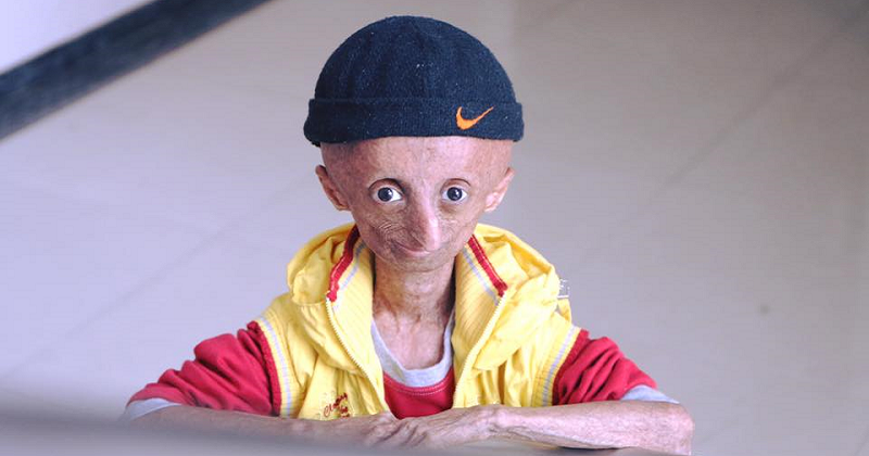 Nihal Bitla, Face Of 'Progeria' In India, Dies at 15 (1)
