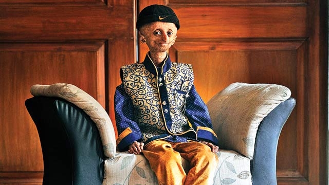 Nihal Bitla, Face Of 'Progeria' In India, Dies at 15 (1)