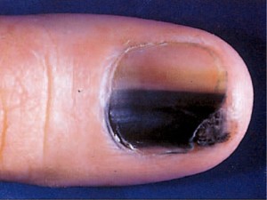 Cancer spot on fingers