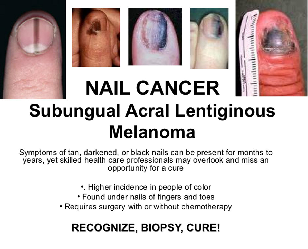 Nail Cancer