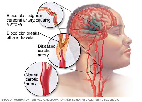 Love Bite affects brain and heart