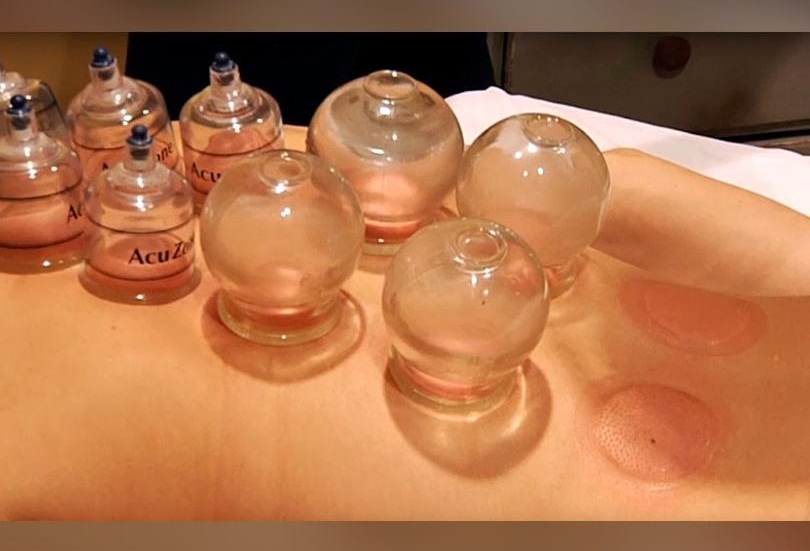 Cupping process