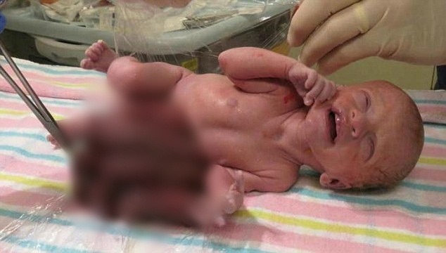 Boy born with intestines outside