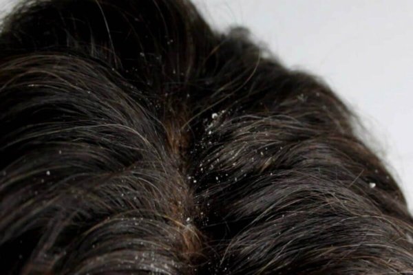 dandruff - PCOS Chin hair