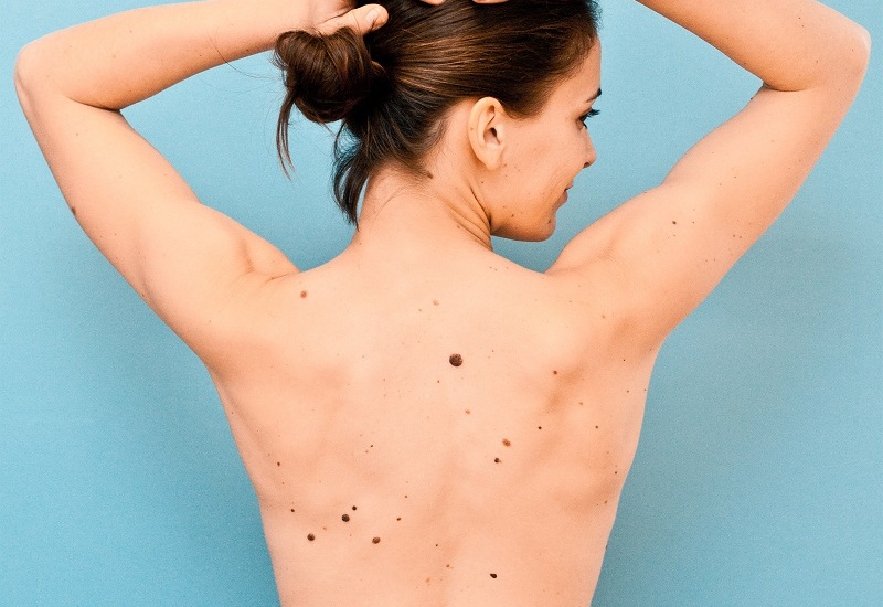 Mandatory Credit: Photo by Burger/Phanie/REX (1614322a) Model released - Moles on the back of a woman. Various
