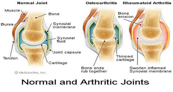 normal-and-arthritic-joint