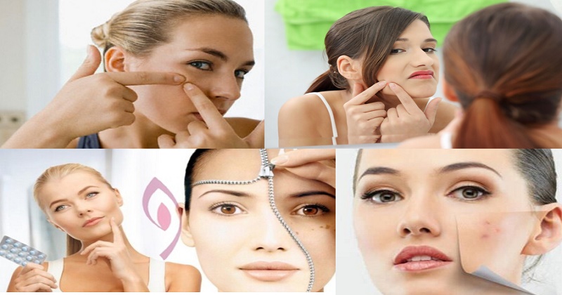 how-to-get-rid-of-pimples