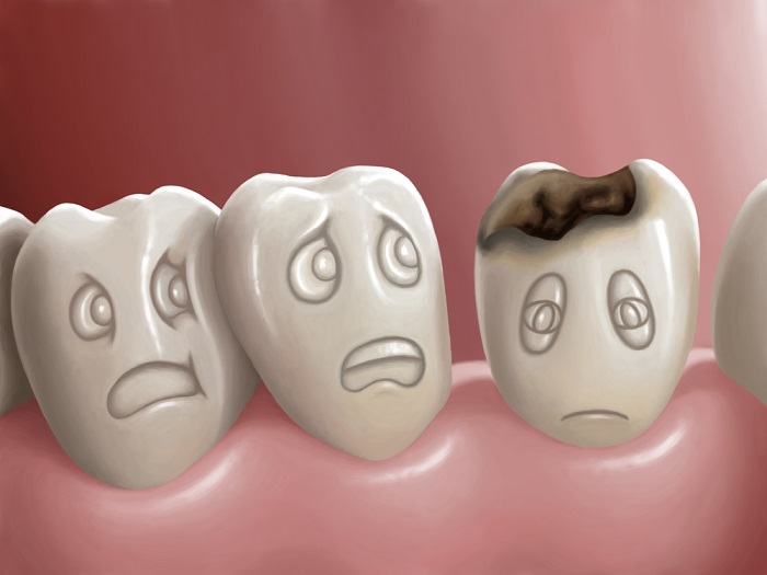 dental issues - Signs That You Are Eating Too Much Sugar