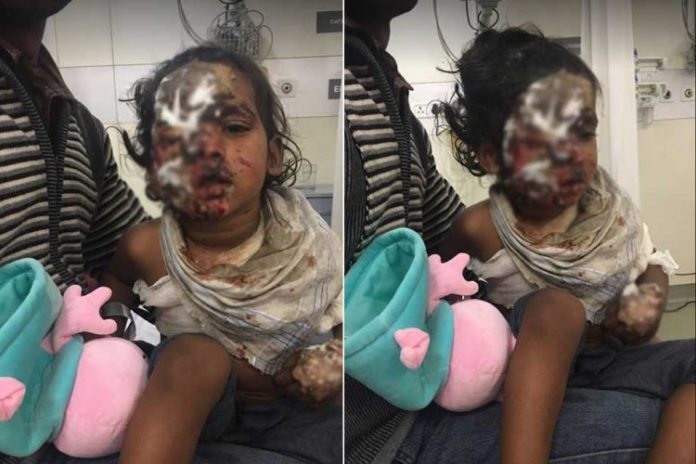 Two-Year-Old Boy Attacked With Acid When His Mother Refused Sexual Advances Of Neighbor