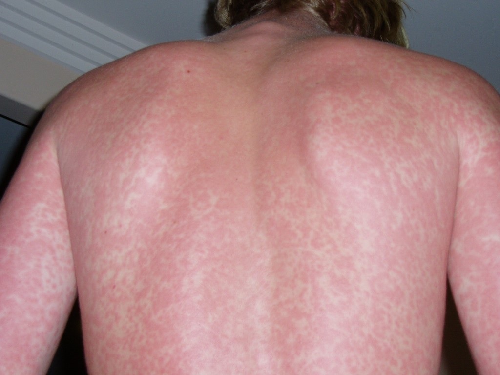 skin rashes