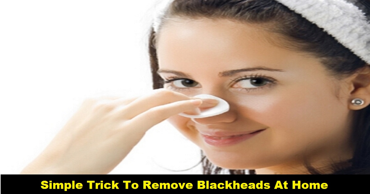 Remove Blackheads At Home With This One Simple And Effective Trick 3009