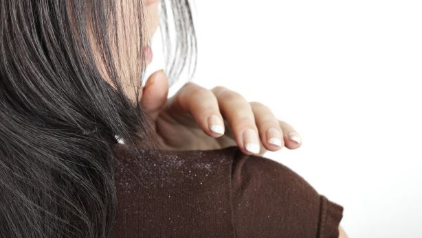21 Amazing Tips On How To Get Rid Of Dandruff Naturally At Home