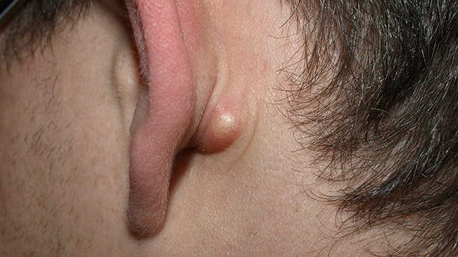 causes of lump behind ears