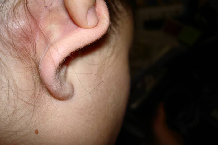 bump behind ear