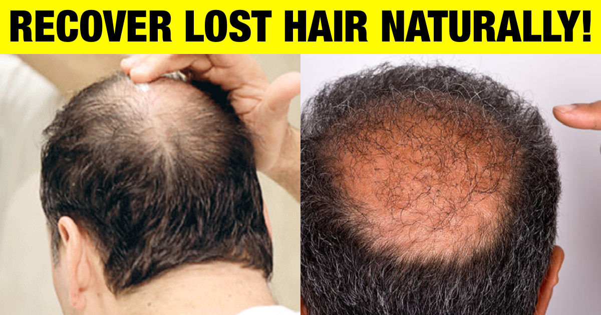 You Can Grow Back Your Lost Hair Naturally With These 9 Home-Made  Activities! Here's How