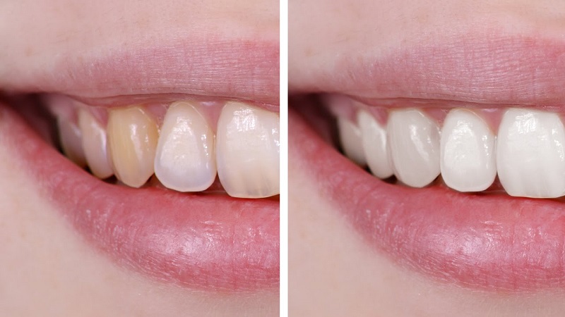 Whiten Your Teeth In Just 2 Minutes With This Simple Home Remedy (3)