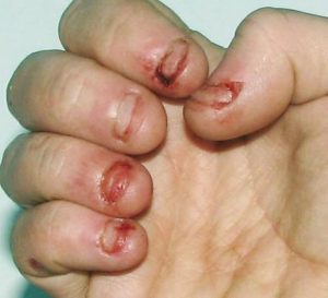 11-Horrifying-Facts-That-Will-Never-Let-You-Bite-Your-Dirty-Nails-Again-1-300x273