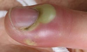 11-Horrifying-Facts-That-Will-Never-Let-You-Bite-Your-Dirty-Nails-Again-15-300x180