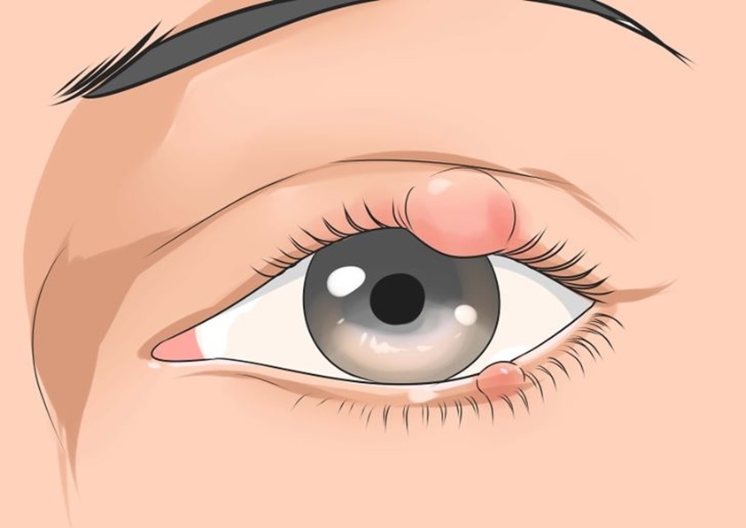 eye-stye-remedies