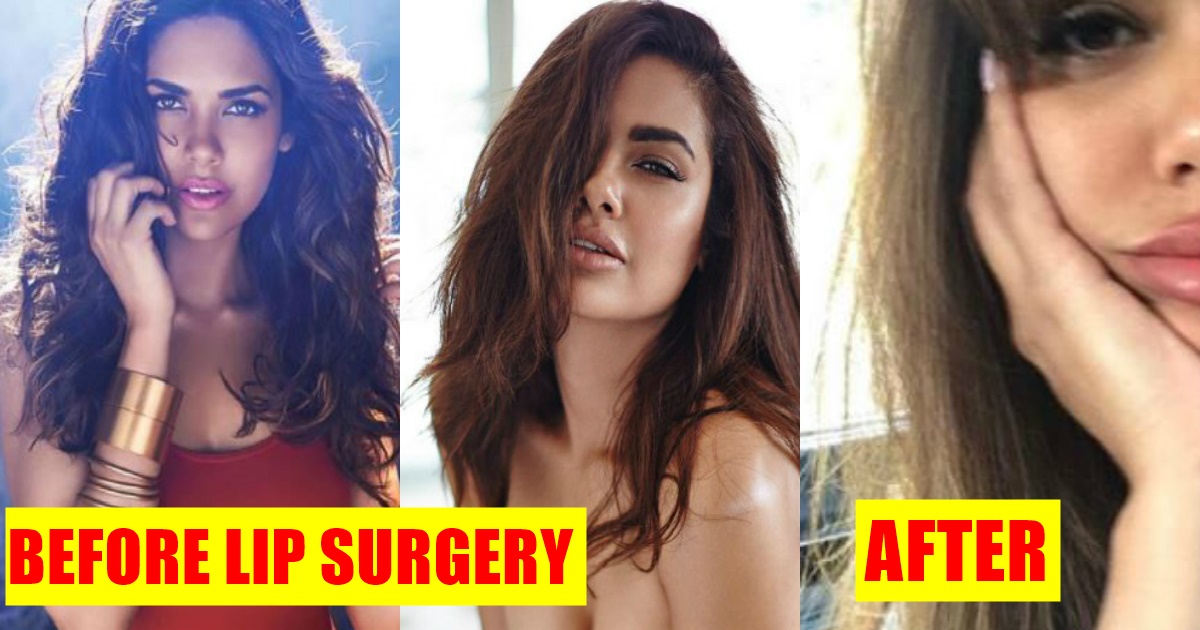 Instagram Bomb Esha Gupta Undergoes Extensive Lip-Surgery Which Only