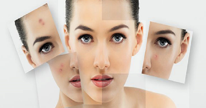 The Position Of Your Acne Reveals A lot About Your Health (1)