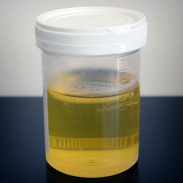 dark yellow urine problems and side effects