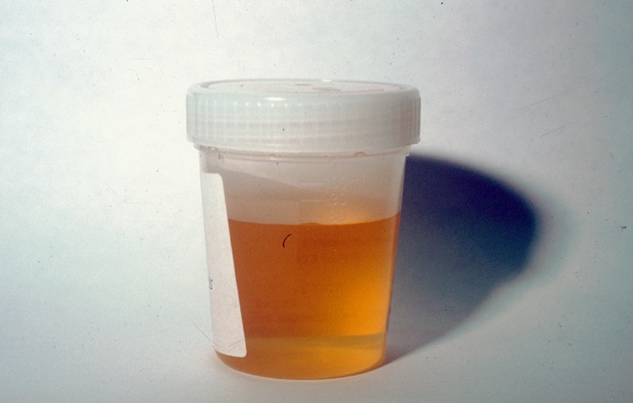 Dark yellow-orange urine during treatment with clofazimine. Copyright ITM
