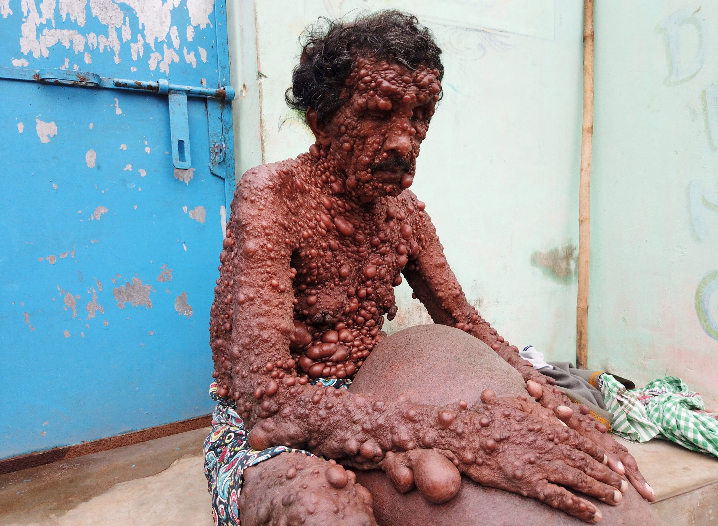 Indian Man With Extremely Rare Skin Disease Is Covered In ...