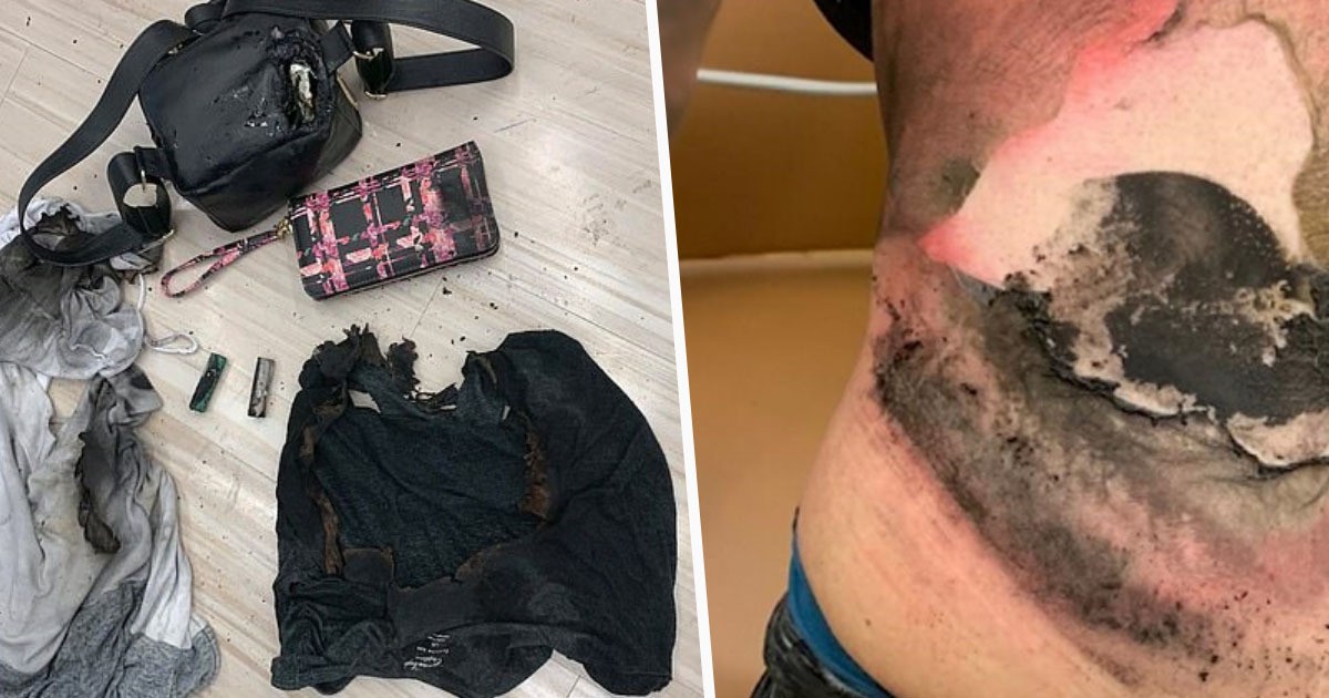 Vape Explodes Inside Backpack Of Woman, Burns 20 Percent Of Her Body