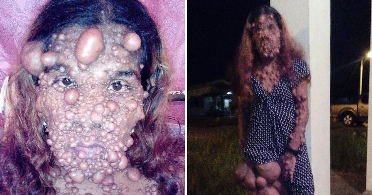 Woman Left With Thousands Of Tumors All Over Her Body