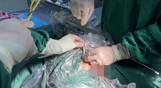 10YearOld Boy Has 5ft Cable Removed From Blad