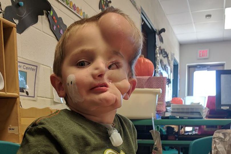 5-Year-Old Boy Left With Disfigured Face After Horrible ...