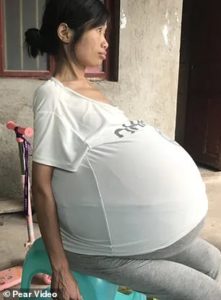 Mysterious Condition Leaves Chinese Woman’s Belly Growing Uncontrollably