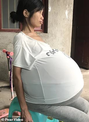 Mysterious Condition Leaves Chinese Woman’s Belly Growing Uncontrollably